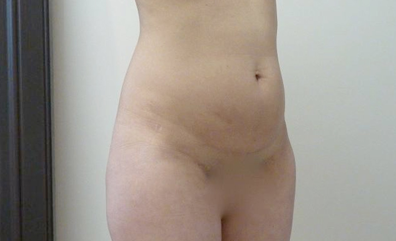Liposuction in Chicago, IL  Lipectomy Fat Removal River North